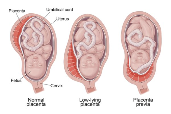 Placenta Previa - Specialist Gynaecology Treatment at First Care Clinic